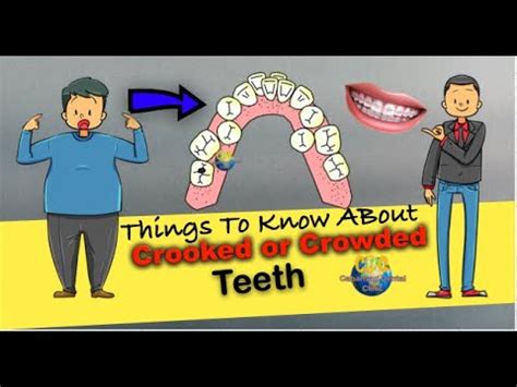 sungki na ngipin in english|Things to know about crooked or crowded teeth: .